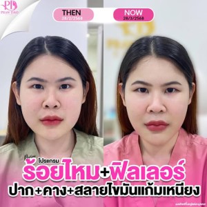 ประกาศ สินค้า ลดริ้วรอย ยกกระชับ เสริมความงามอุด อุดร-ฉีดโบท็อก ฉีดฟิลเลอร์อุดรธานี